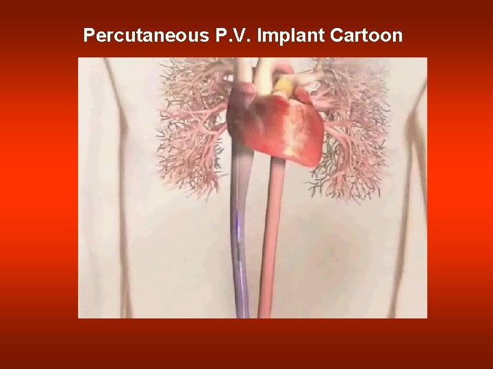 Percutaneous P. V. Implant Cartoon 