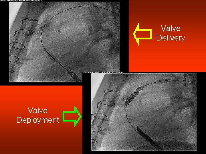 Valve Delivery Valve Deployment 