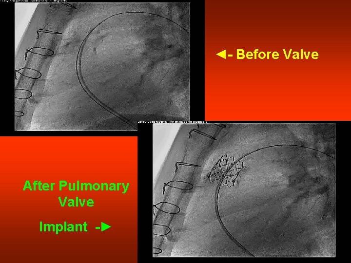 ◄- Before Valve After Pulmonary Valve Implant -► 