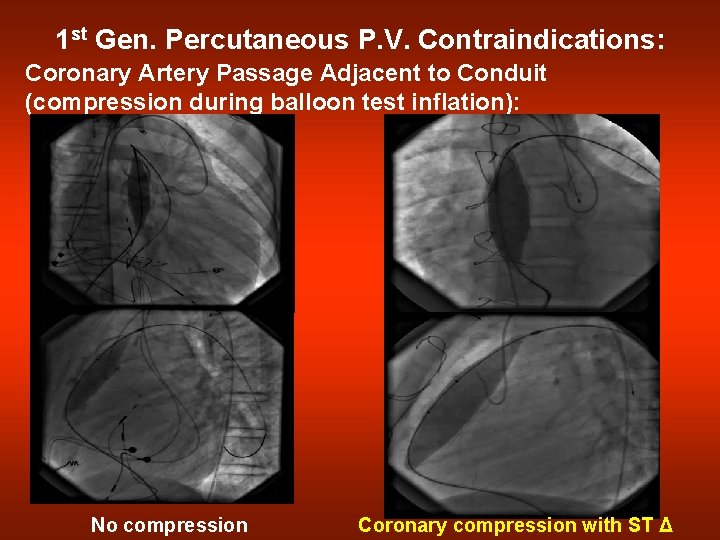 1 st Gen. Percutaneous P. V. Contraindications: Coronary Artery Passage Adjacent to Conduit (compression