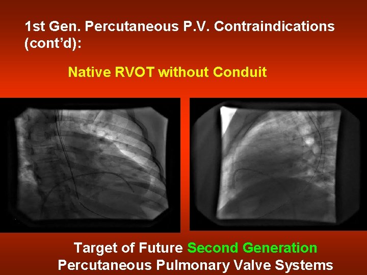 1 st Gen. Percutaneous P. V. Contraindications (cont’d): Native RVOT without Conduit Target of