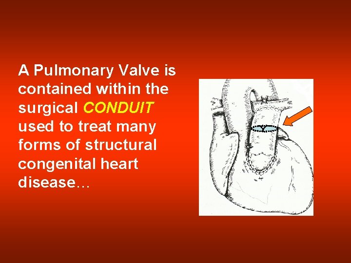 A Pulmonary Valve is contained within the surgical CONDUIT used to treat many forms