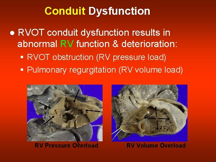 Conduit Dysfunction ● RVOT conduit dysfunction results in abnormal RV function & deterioration: §