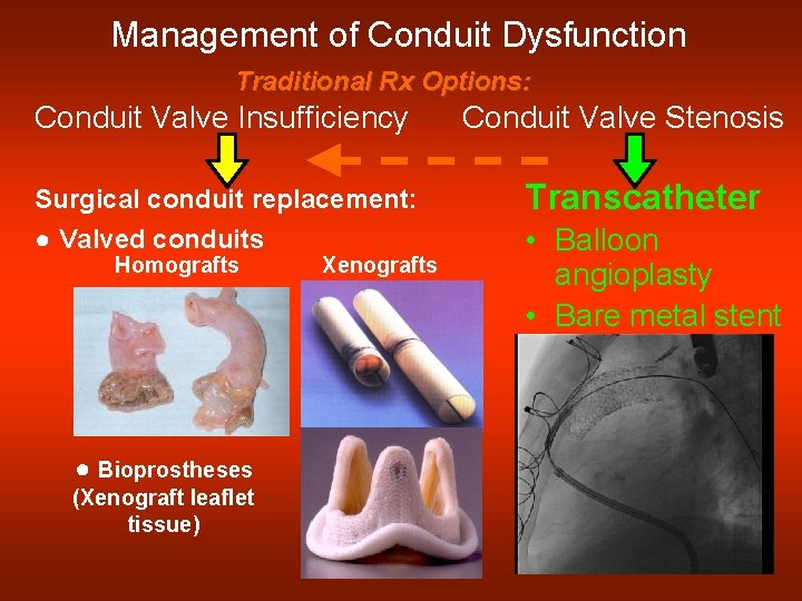 Management of Conduit Dysfunction Traditional Rx Options: Conduit Valve Insufficiency Conduit Valve Stenosis Surgical