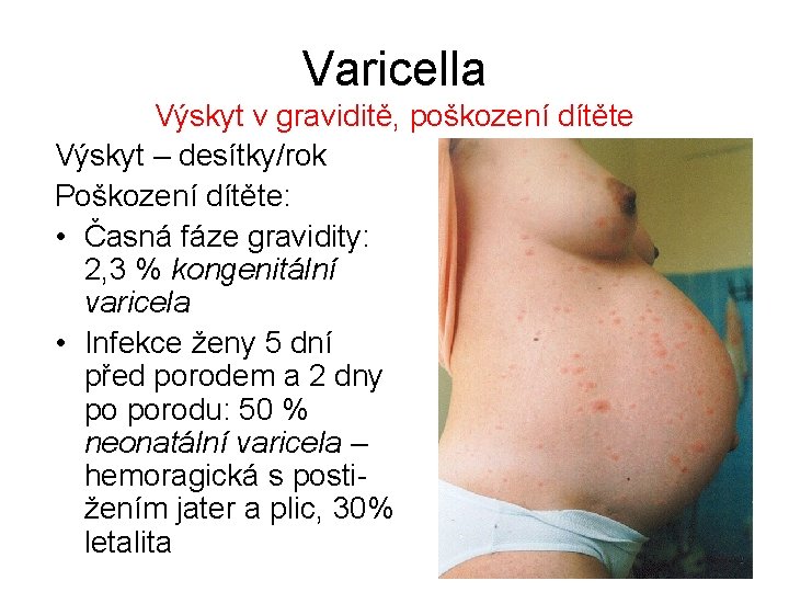 Varicella Výskyt v graviditě, poškození dítěte Výskyt – desítky/rok Poškození dítěte: • Časná fáze