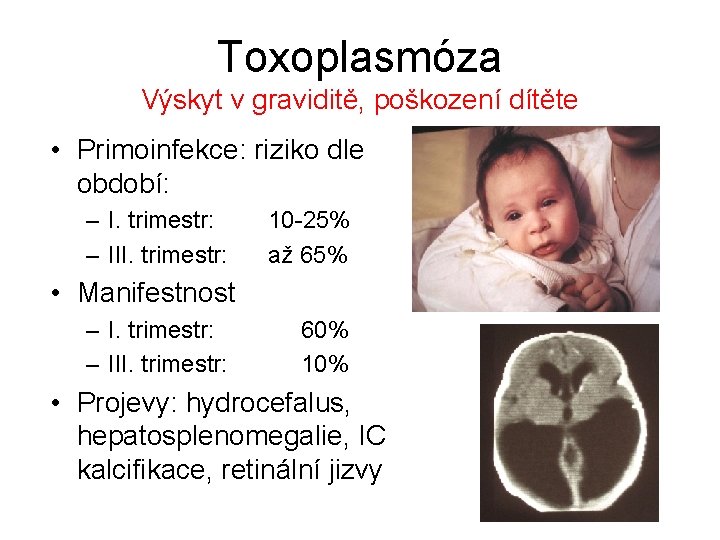 Toxoplasmóza Výskyt v graviditě, poškození dítěte • Primoinfekce: riziko dle období: – I. trimestr: