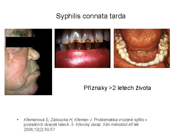Syphilis connata tarda Příznaky >2 letech života • Křemenová S, Zákoucká H, Křemen J.