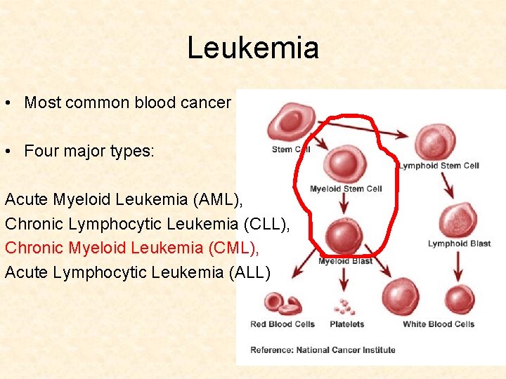 Leukemia • Most common blood cancer • Four major types: Acute Myeloid Leukemia (AML),