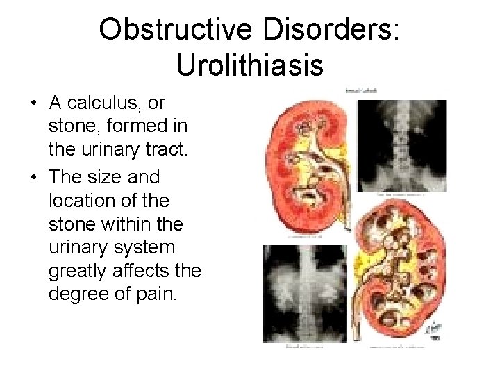 Obstructive Disorders: Urolithiasis • A calculus, or stone, formed in the urinary tract. •