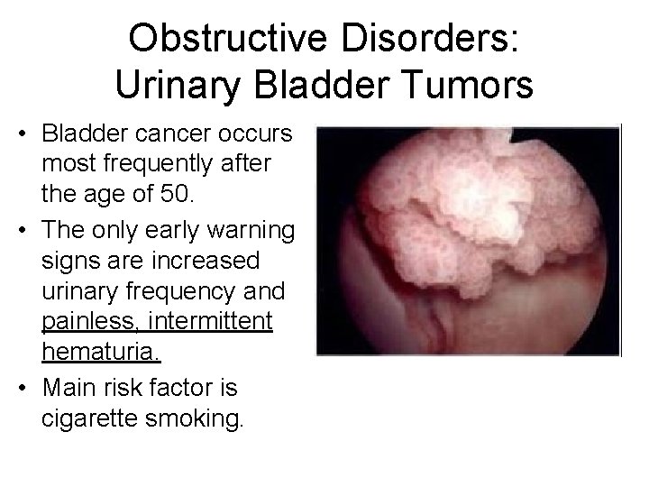 Obstructive Disorders: Urinary Bladder Tumors • Bladder cancer occurs most frequently after the age