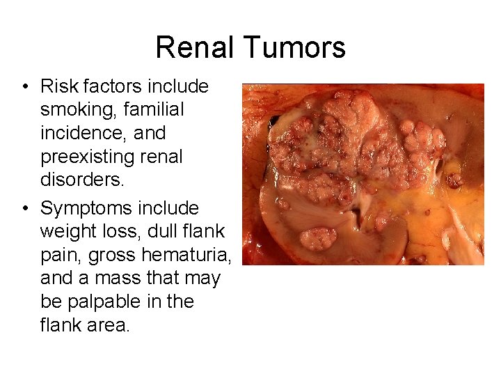 Renal Tumors • Risk factors include smoking, familial incidence, and preexisting renal disorders. •