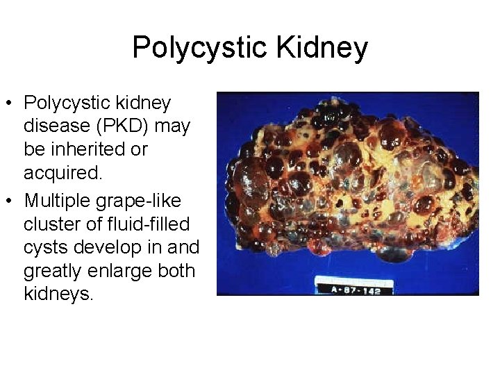 Polycystic Kidney • Polycystic kidney disease (PKD) may be inherited or acquired. • Multiple