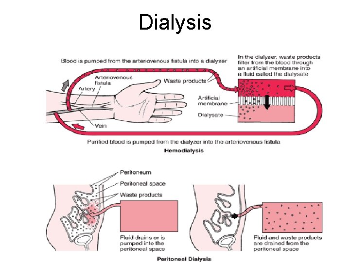 Dialysis 