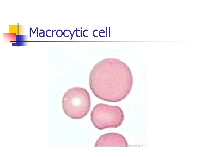 Macrocytic cell 