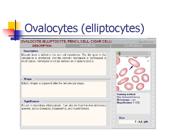 Ovalocytes (elliptocytes) 