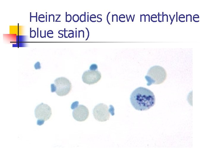 Heinz bodies (new methylene blue stain) 