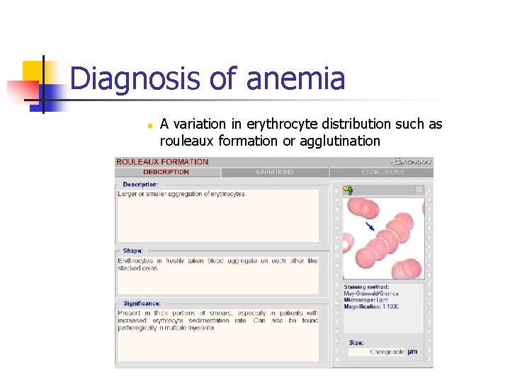 Diagnosis of anemia n A variation in erythrocyte distribution such as rouleaux formation or