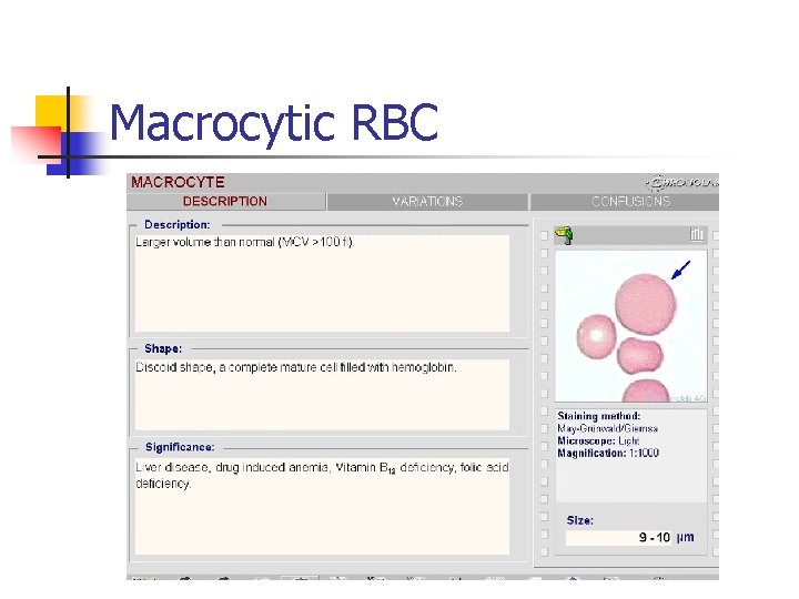 Macrocytic RBC 