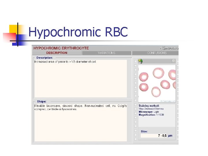 Hypochromic RBC 