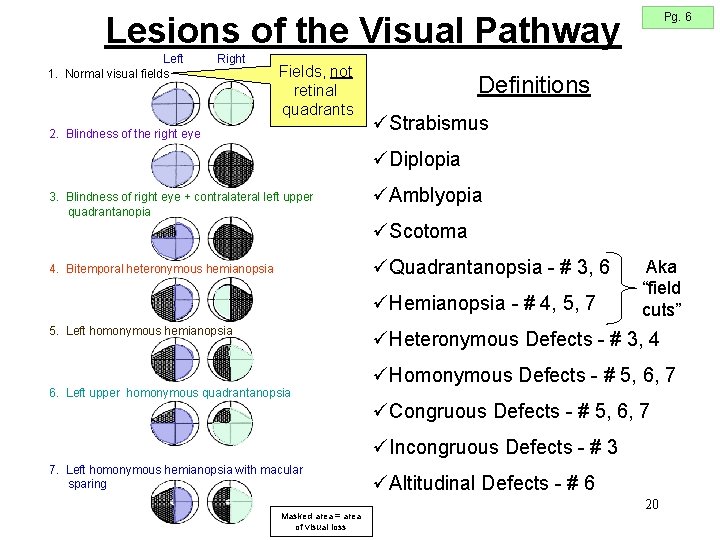 Pg. 6 Lesions of the Visual Pathway Left 1. Normal visual fields Right Fields, Pg. 6 Lesions of the Visual Pathway Left 1. Normal visual fields Right Fields,