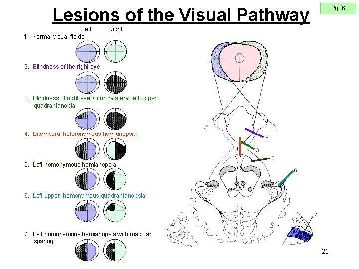 Pg. 6 Lesions of the Visual Pathway Left 1. Normal visual fields Right 2. Pg. 6 Lesions of the Visual Pathway Left 1. Normal visual fields Right 2.