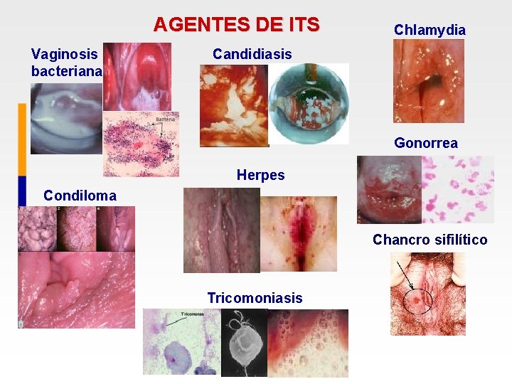 AGENTES DE ITS Vaginosis bacteriana Chlamydia Candidiasis Gonorrea Herpes Condiloma Chancro sifilítico Tricomoniasis 