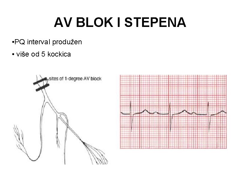 AV BLOK I STEPENA • PQ interval produžen • više od 5 kockica AV BLOK I STEPENA • PQ interval produžen • više od 5 kockica