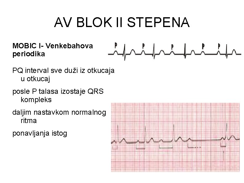 AV BLOK II STEPENA MOBIC I- Venkebahova periodika PQ interval sve duži iz otkucaja