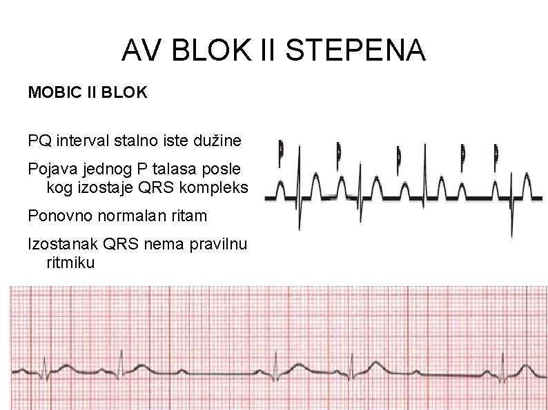 AV BLOK II STEPENA MOBIC II BLOK PQ interval stalno iste dužine Pojava jednog AV BLOK II STEPENA MOBIC II BLOK PQ interval stalno iste dužine Pojava jednog