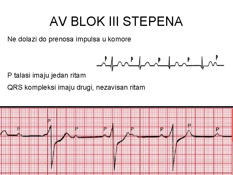 AV BLOK III STEPENA Ne dolazi do prenosa impulsa u komore P talasi imaju