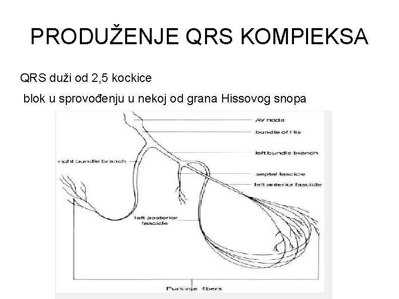 PRODUŽENJE QRS KOMPl. EKSA QRS duži od 2, 5 kockice blok u sprovođenju u