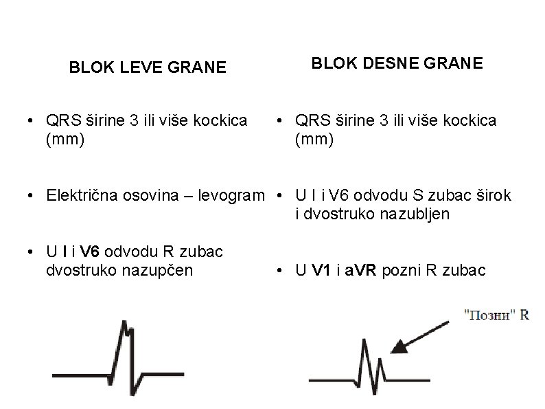BLOK LEVE GRANE • QRS širine 3 ili više kockica (mm) BLOK DESNE GRANE