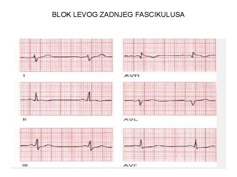 BLOK LEVOG ZADNJEG FASCIKULUSA 