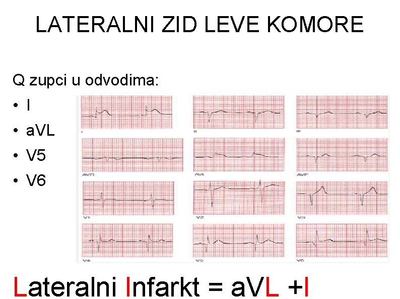 LATERALNI ZID LEVE KOMORE Q zupci u odvodima: • I • a. VL •