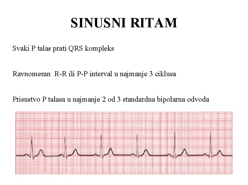 SINUSNI RITAM Svaki P talas prati QRS kompleks Ravnomeran R-R ili P-P interval u