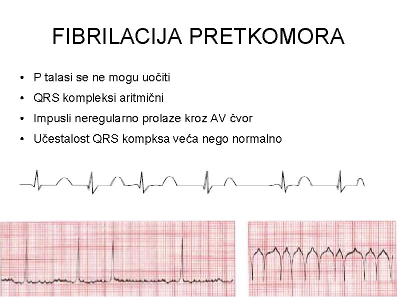 FIBRILACIJA PRETKOMORA • P talasi se ne mogu uočiti • QRS kompleksi aritmični •