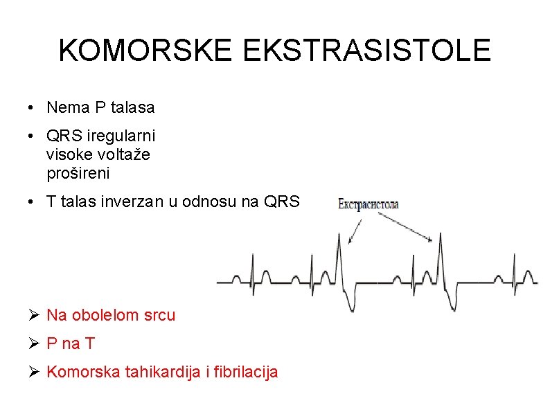 KOMORSKE EKSTRASISTOLE • Nema P talasa • QRS iregularni visoke voltaže prošireni • T