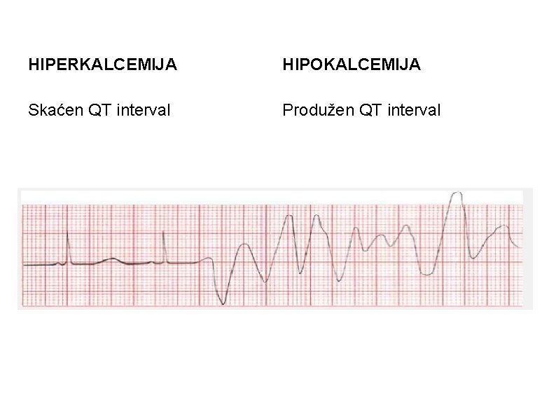 HIPERKALCEMIJA HIPOKALCEMIJA Skaćen QT interval Produžen QT interval 