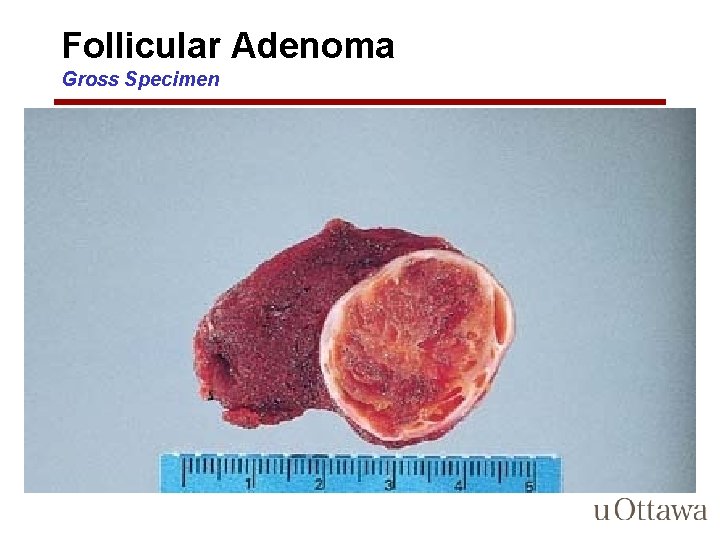 Follicular Adenoma Gross Specimen 