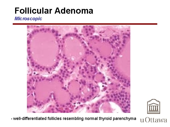 Follicular Adenoma Microscopic • well-differentiated follicles resembling normal thyroid parenchyma 