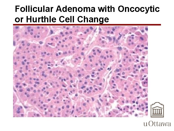 Follicular Adenoma with Oncocytic or Hurthle Cell Change 