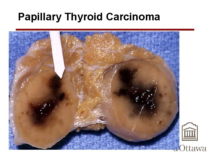 Papillary Thyroid Carcinoma 