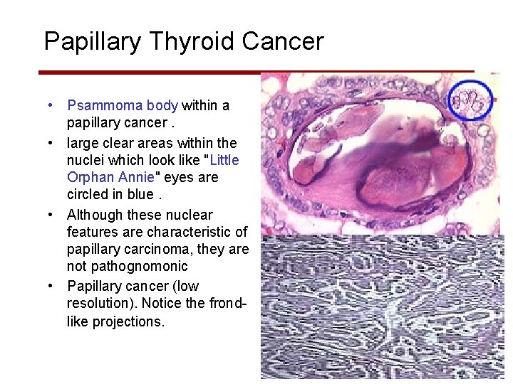 Papillary Thyroid Cancer • Psammoma body within a papillary cancer. • large clear areas