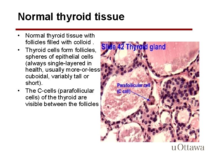 Normal thyroid tissue • Normal thyroid tissue with follicles filled with colloid. • Thyroid