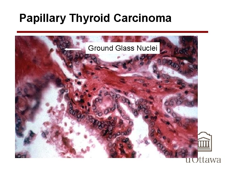 Papillary Thyroid Carcinoma Ground Glass Nuclei 