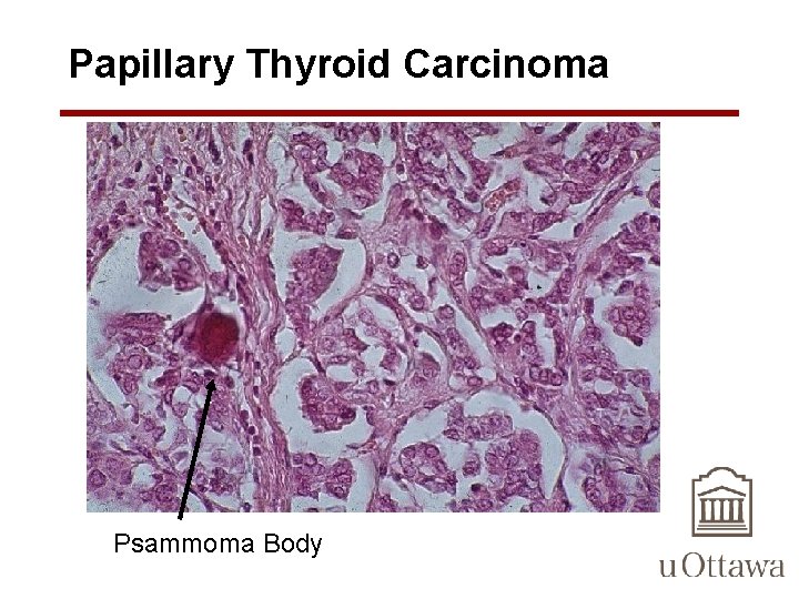 Papillary Thyroid Carcinoma Psammoma Body 