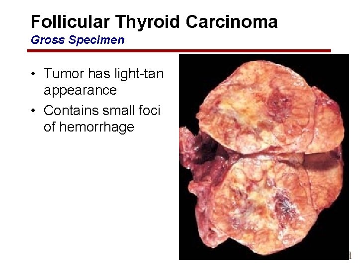 Follicular Thyroid Carcinoma Gross Specimen • Tumor has light-tan appearance • Contains small foci