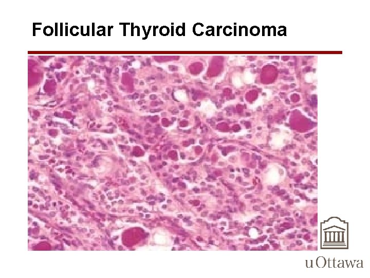 Follicular Thyroid Carcinoma 