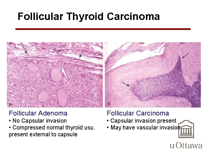 Follicular Thyroid Carcinoma Follicular Adenoma Follicular Carcinoma • No Capsular invasion • Compressed normal