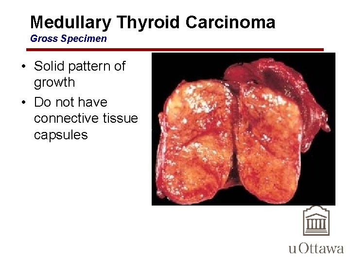 Medullary Thyroid Carcinoma Gross Specimen • Solid pattern of growth • Do not have